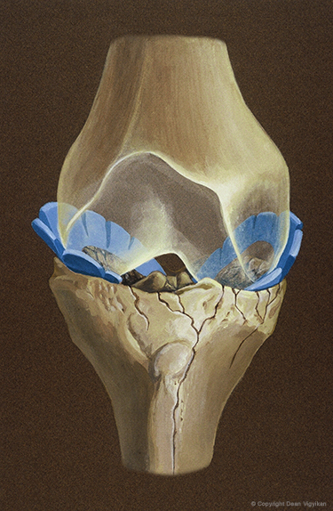 knee, joint, meniscus, injury, medical, legal, illustration, femur